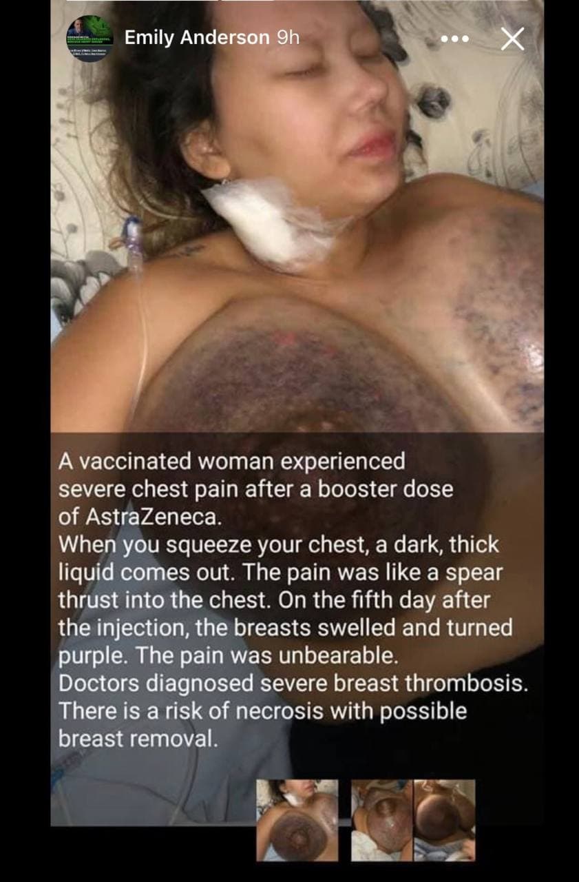 Chest Pain After Covid Vaccine