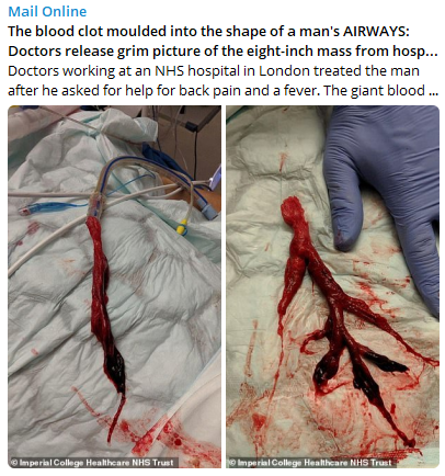 Blood Clot in Lungs